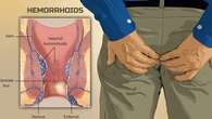 Hemoroid Adalah: Gejala, Penyebab, Tipe-Tipe, dan Cara Mengatasi