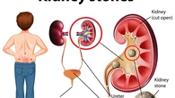 Retrograde Intrarenal Surgery, Solusi Minimal Invasif Atasi Batu Ginjal dan Masalah Salura...