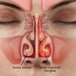 Berbahaya, Jangan Sepelekan Bahaya Konka Hidung Membengkak