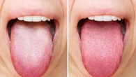 Warna Lidah Bisa Jadi Cermin Kesehatan Tubuh, Begini Cara Mengenalinya