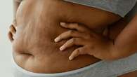 Mengatasi Stretch Mark pada Remaja, Penyebab Umum dan Langkah Pencegah