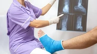 Osteoporosis Kerap Diabaikan, Padahal Bisa Dicegah