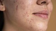 7 Tanda Skin Barrier Rusak, Ini Penyebab dan Cara Mengembalikannya