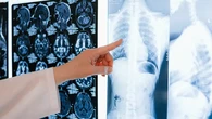 Berisiko Tinggi Kanker Paru-Paru, Dokter Sebut 3 Kelompok Ini Perlu Skrining