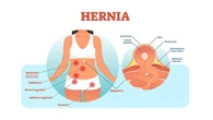 Hernia adalah Penyakit Turun Berok, Kenali Gejala dan Cara Mengobatinya