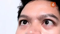 Mata Juling atau Strabismus Bisa Dialami Anak hingga Dewasa, Ini Penyebabnya