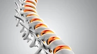 Tulang Rapuh Bukan Ujug-Ujug Terjadi, Kenali Gejala Osteoporosis Sejak Dini