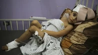 Pilu Nasib Anak-Anak di Gaza Luka Parah, Dokter Kehabisan Obat Bius dan Antibiotik