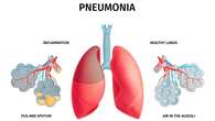 Pneumonia: Ancaman Serius bagi Balita, Ketahui Kapan Harus ke Rumah Sakit