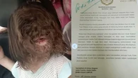 Ratu Malaysia Berencana Adopsi Anak Berusia 2 Tahun Penderita Sindrom Manusia Serigala