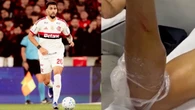 Com Ancelotti de olho, Paquetá escapa de fratura antes da Copa