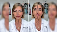 Médica aplica botox em metade do rosto e choca com resultado