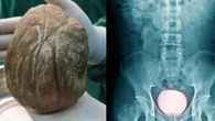 Pedra gigante de 1,3kg é retirada da bexiga de homem