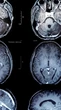 Vacina é a nova esperança contra tumores cerebrais