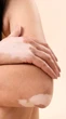 Convivendo com o vitiligo: condição pede cuidados específicos