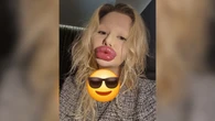 Antes e depois de mulher com lábios gigantes chama atenção da web
