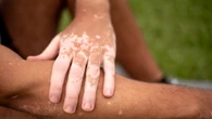 Manchas brancas na pele podem ser sinal de vitiligo