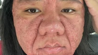 Acne gravídica: como a gravidez afeta a pele da gestante
