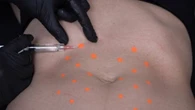 Estética se alia à medicina regenerativa no combate à flacidez