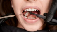 Vai
tirar o dente do siso? Confira os principais cuidados