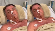 Como é a reconstrução do trânsito intestinal feita por Bolsonaro