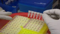 Paciente com suspeita de Ebola é diagnosticado com meningite