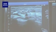 乳がん 超音波検査で医師をサポートするAI活用機器が導入