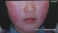 リンゴ病の患者数 前週から0.08人減も流行続く