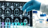 Alzheimer’s breakthrough: Cheap blood test can ‘detect early signs' of brain disease