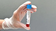 C'est ma santé. Un test sérologique pour éviter une seconde dose de vaccin contre le Covid si on a déjà été malade