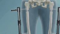 Chirurgie esthétique : la Turquie, eldorado de l’allongement des jambes