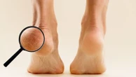 Pourquoi vos pieds sentent-ils le fromage ?