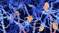 Sclerosi multipla: una diagnosi ogni tre ore. Una nuova strategia per aiutare i pazienti