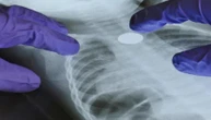 Tumore del polmone: il Dna ci dice se la terapia è utile