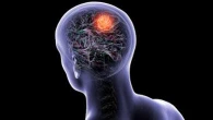 Glioblastoma, nei maschi il testosterone sembra rallentare la malattia