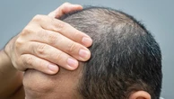 Finasteride, alert EMA: pensieri suicidari tra i possibili effetti collaterali del farmaco