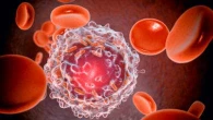 Leucemia mieloide acuta: l’italiana che sfida le recidive