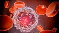 Leucemia mieloide acuta: l’italiana che sfida le recidive