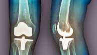 Protesi in simultanea a entrambe le ginocchia: senza dolore è possibile