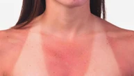 Sunburn Challenge, la gara delle scottature sulla pelle racconta il malessere dei giovani