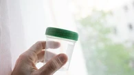 Tumore alla prostata, meno biopsie di controllo con un nuovo test sulle urine