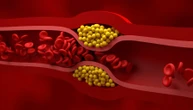 Terapia su misura: così può calare il rischio d’infarto (e non solo) dopo l’angioplastica