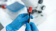Tumori, l’appello degli oncologi per biopsia liquida e terapie mirate