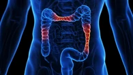 Colite ulcerosa, un anticorpo monoclonale apre nuove prospettive di trattamento