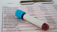 Non solo colesterolo, c’è un altro test del sangue per capire se c’è rischio infarto e ictus
