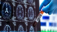 Alzheimer, approvato negli Usa primo test per diagnosi precoce con solo prelievo di sangue