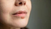 Perché è difficile sviluppare un vaccino efficace e sicuro contro l’Herpes simplex?