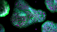 Sclerosi multipla, grazie ai “cervelli” in provetta si accelera lo sviluppo dei farmaci