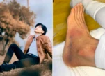 Đan Trường tiết lộ tình trạng sức khoẻ sau khi ngã cầu thang