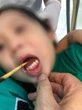 Ngã lúc chơi đùa, bé gái 3 tuổi bị que xiên thịt đâm xuyên lưỡi